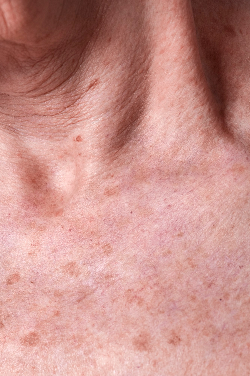 Melasma: Como Identificar, Tratar e Prevenir